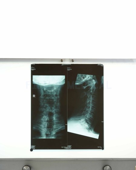 X_Ray Neck + Spine